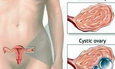 Hội chứng buồng trứng đa nang và cách điều trị
